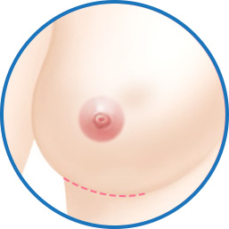 3. 밑주름 절개식