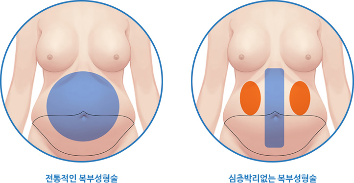 복부성형, 최소박리가 왜 중요한가?