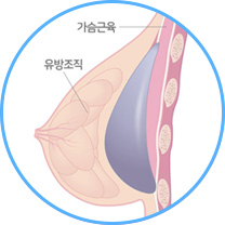 근막 밑 삽입