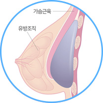 근육 밑 삽입