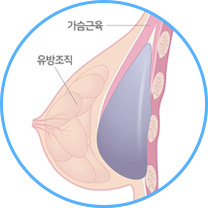 이중평면 삽입