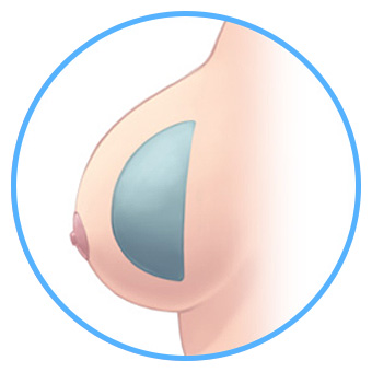 원방형 보형물