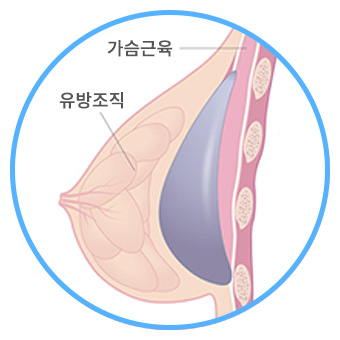 근막 밑 삽입
