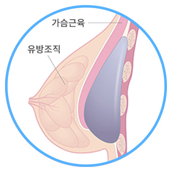 근육 밑 삽입