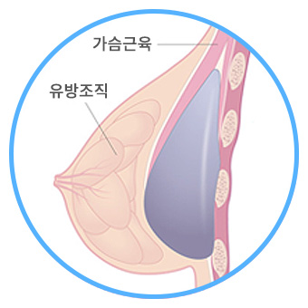 이중평면 삽입