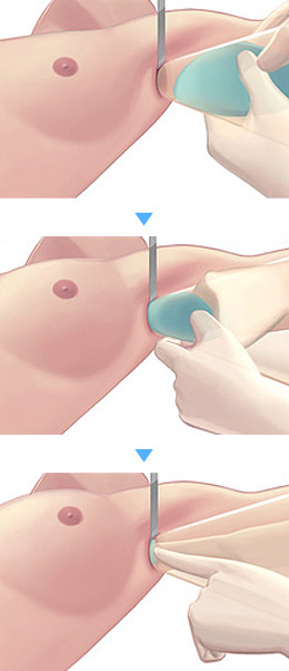 겨드랑이 절개시