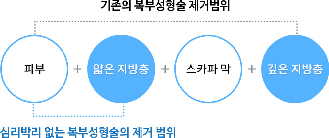 복부성형술