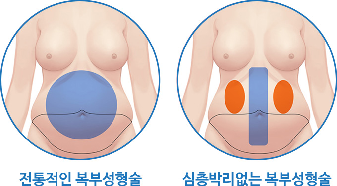 복부성형, 최소박리가 왜 중요한가?