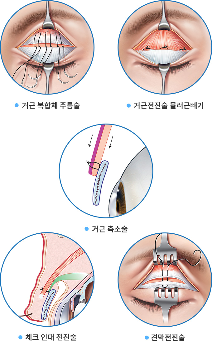 거근 복합체 주름술