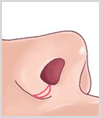 수술방법2