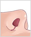 수술방법3