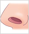 수술방법1