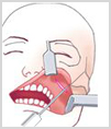 수술방법6