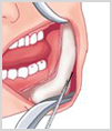 수술방법4
