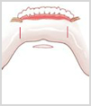 수술방법3