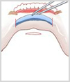 수술방법4